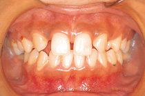 歯科矯正症例01