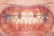 歯科矯正症例02