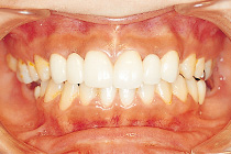 歯科矯正症例03
